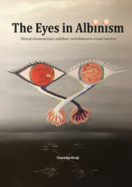 The Eyes in Albinism